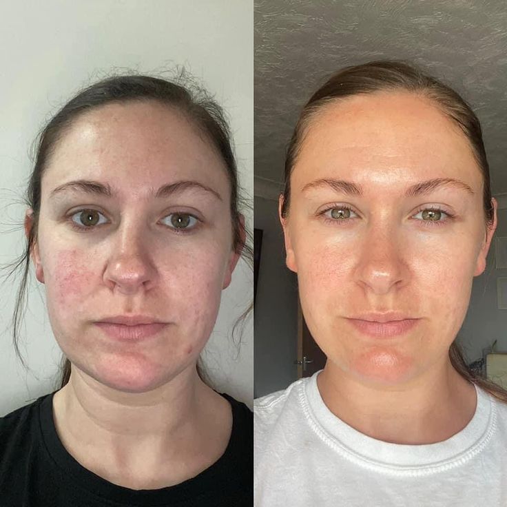 HerGlowelle Rice Peel Shot Serum™